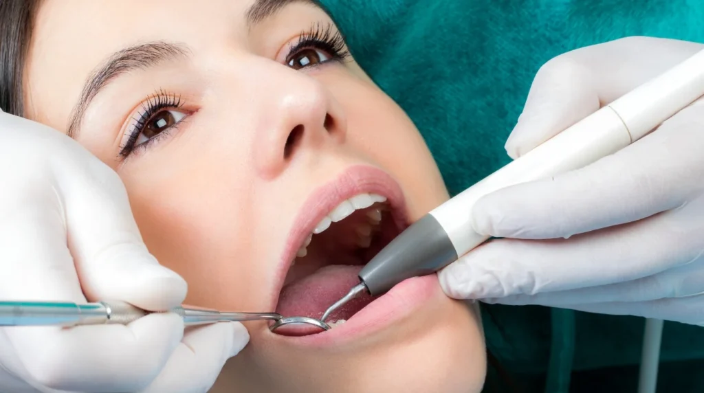 détartrage polissage